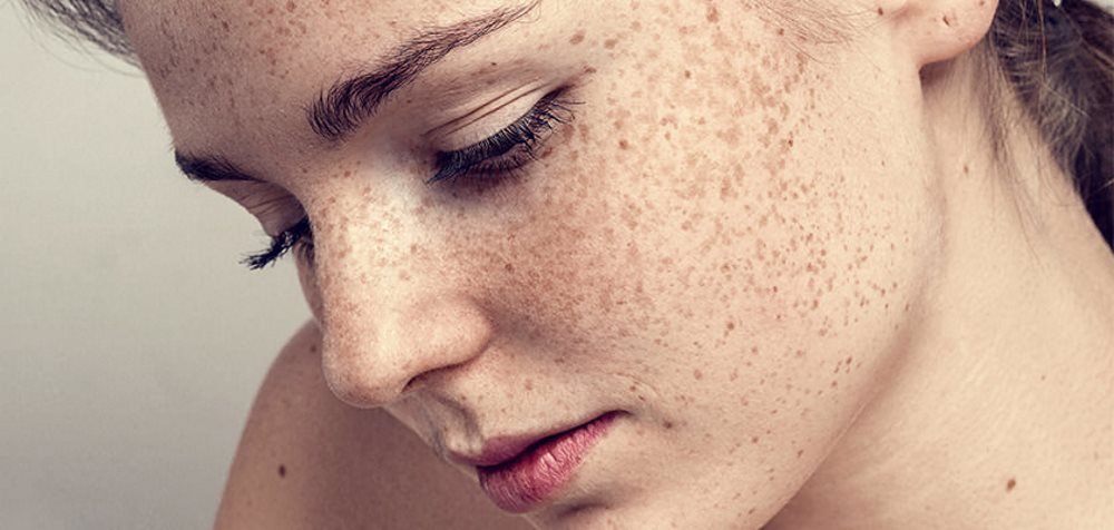 Freckles-Removal-Treatment Freckles Removal Treatment