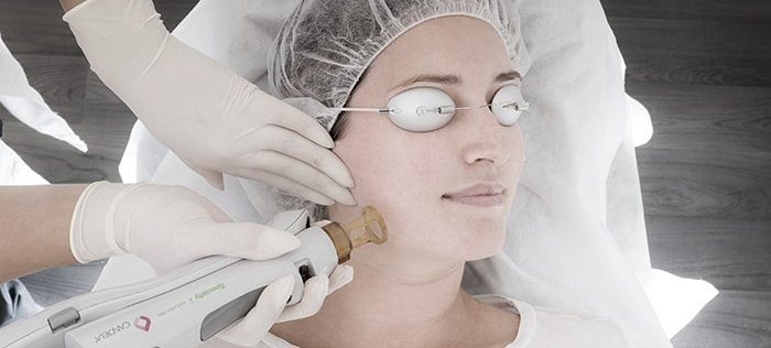 Laser-Skin-Tightening Skin Tightening