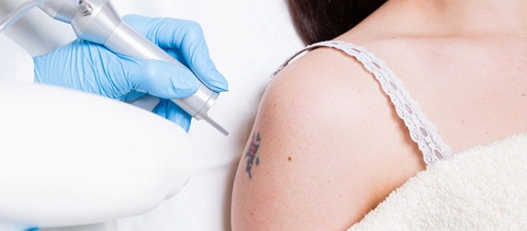 Laser-Tattoo-Removal Laser Tattoo Removal