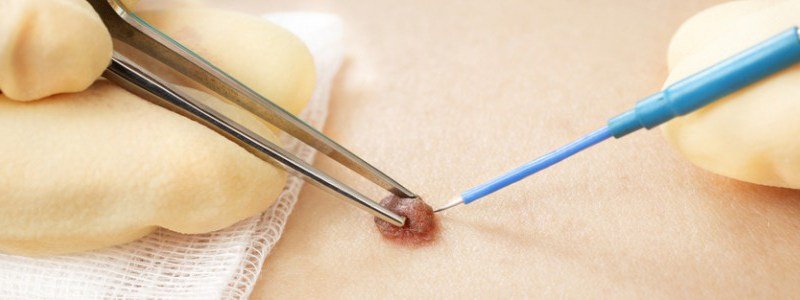 Mole-Removal-Surgery Mole Removal Surgery