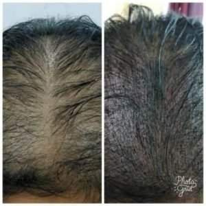 Scalp-microblading-300x300 Scalp Microblading