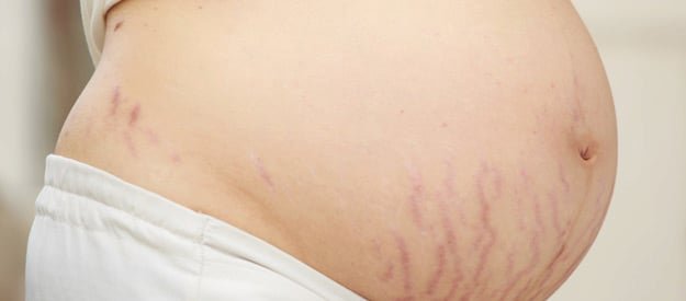 Stretch-Marks-Removal Stretch Marks Removal