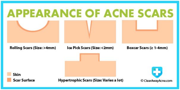 Scar Scar Removal Treatment