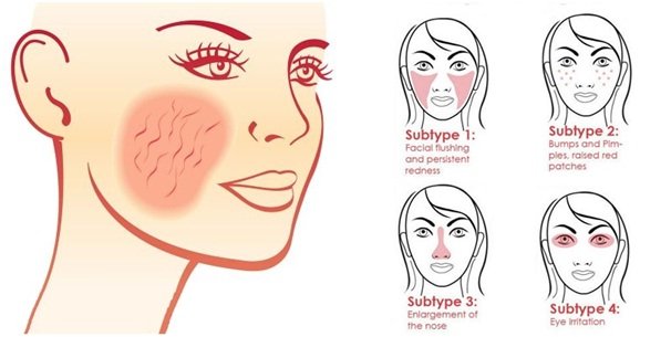 rosacea Dry Sensitive Skin Treatment